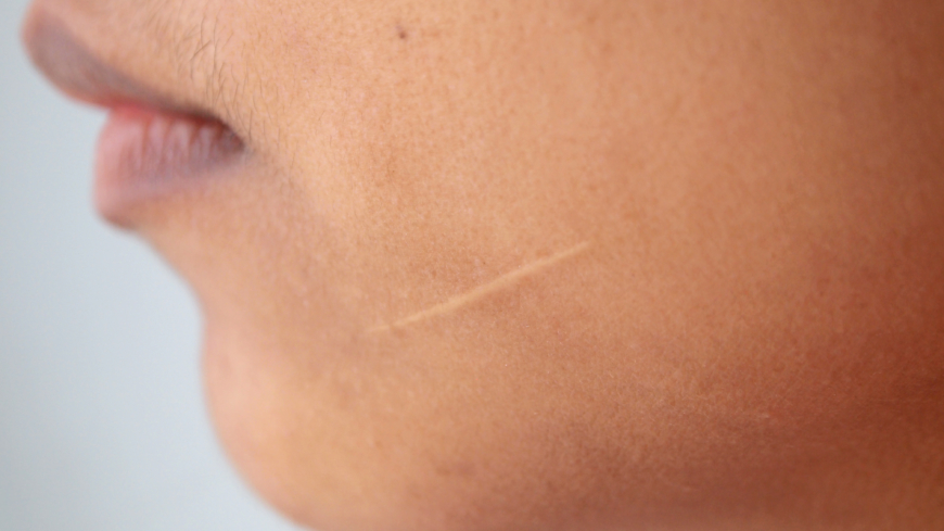 Missat försäkringsersättning vid personskada – så får du ut dina pengar!